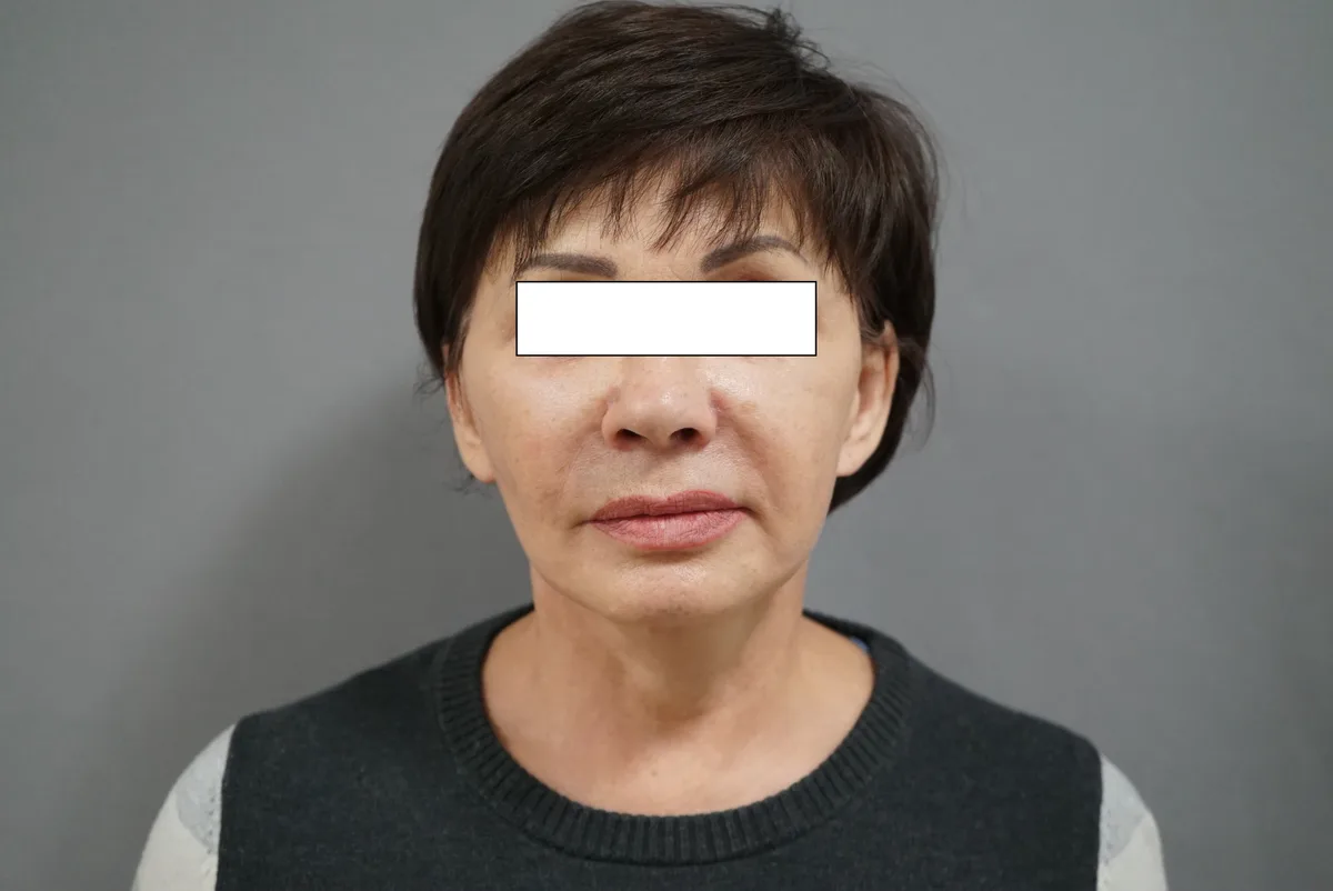 После: Лифтинг лица